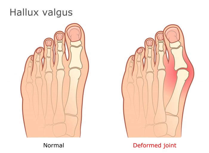 hallux valgus