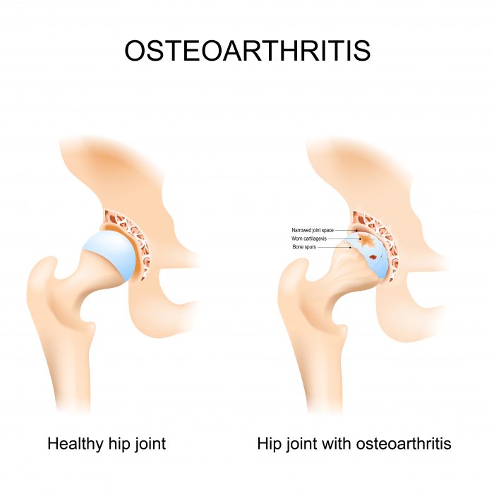 Osteoarthritis diagram