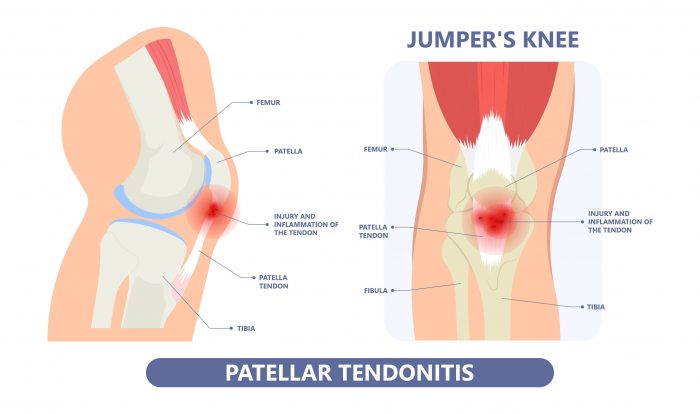 Diagram showing how jumper's knee affects the joint.